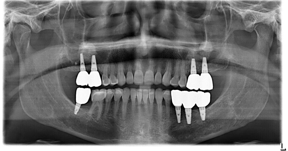 Fig. 30: Final dental panoramic tomogram. 