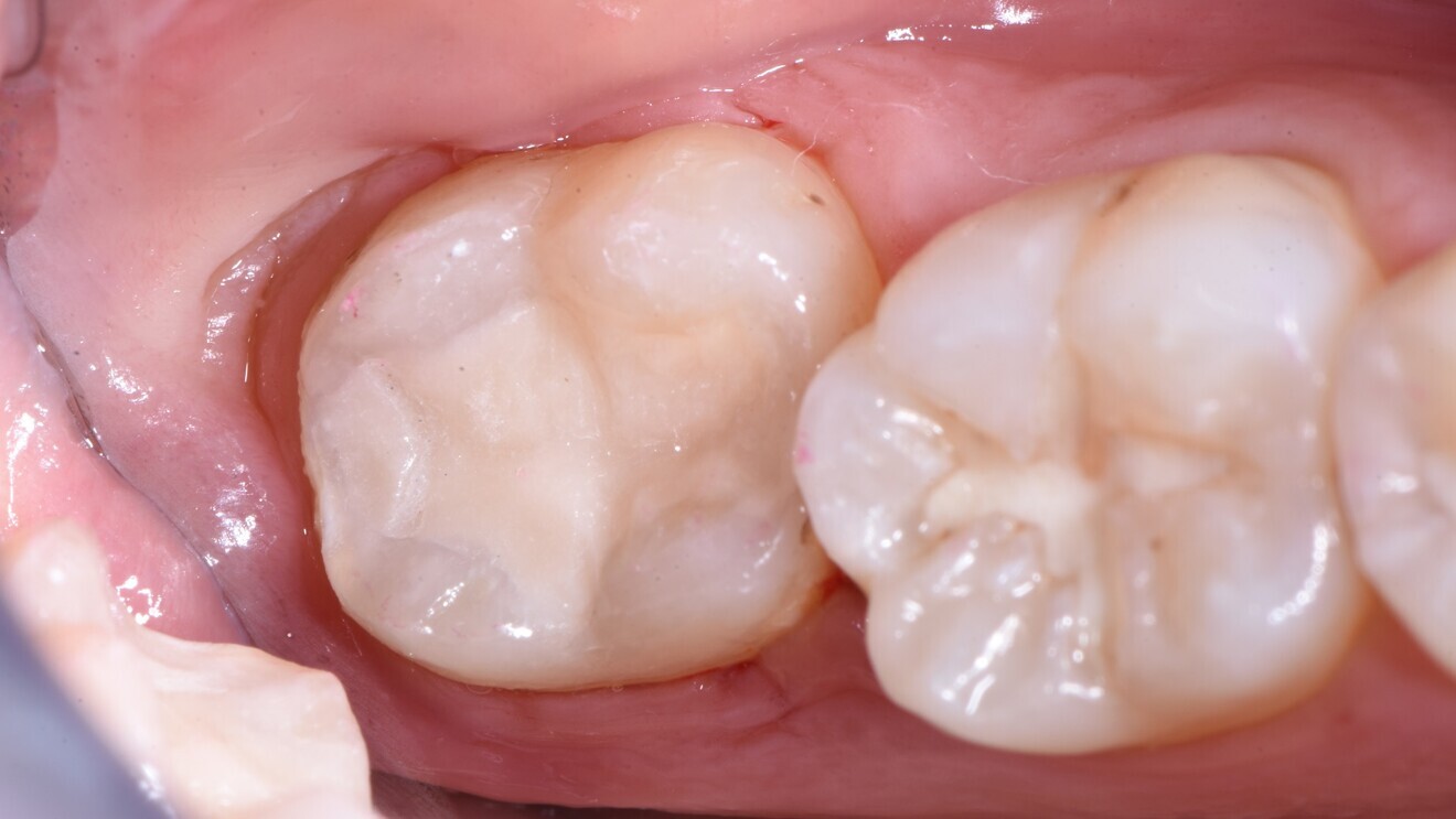 Fig. 5: Class I glass hybrid restoration with EQUIA Forte after placement.  