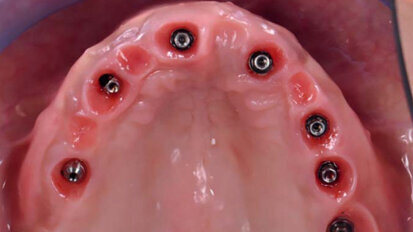 Programme ADF implantologie et radiologie : Penser long terme et progresser dans sa mise en oeuvre