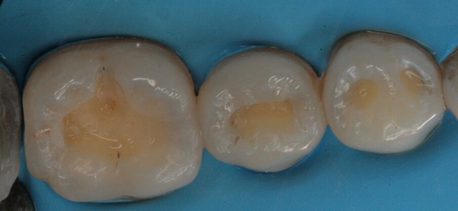 Fig. 26_Preparazione della cavità.