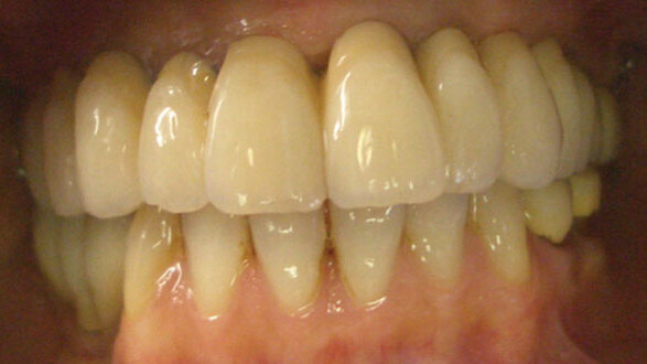 Intraoral welding and lingualized (lingual contact) occlusion: A case report