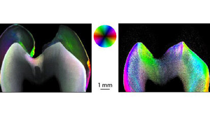 Mit Nanoforschung der Karies auf der Spur