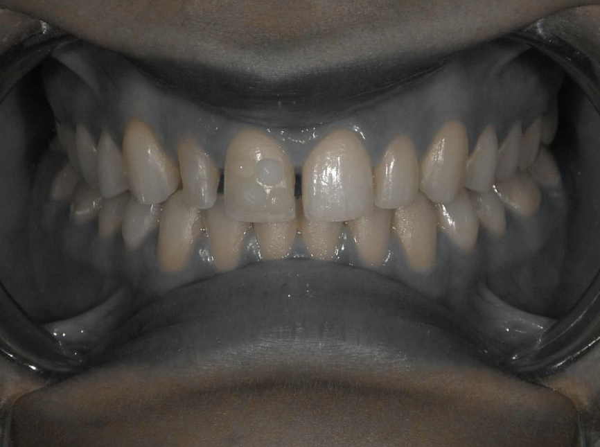 Fig 12 : Shade confirmation using the Isolate Shade Mode of EyeSpecial CII camera