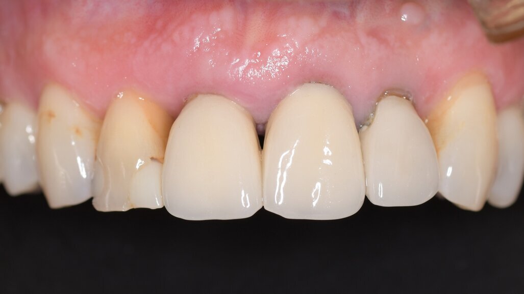 A fully guided digital workflow for predictable implant planning and placement