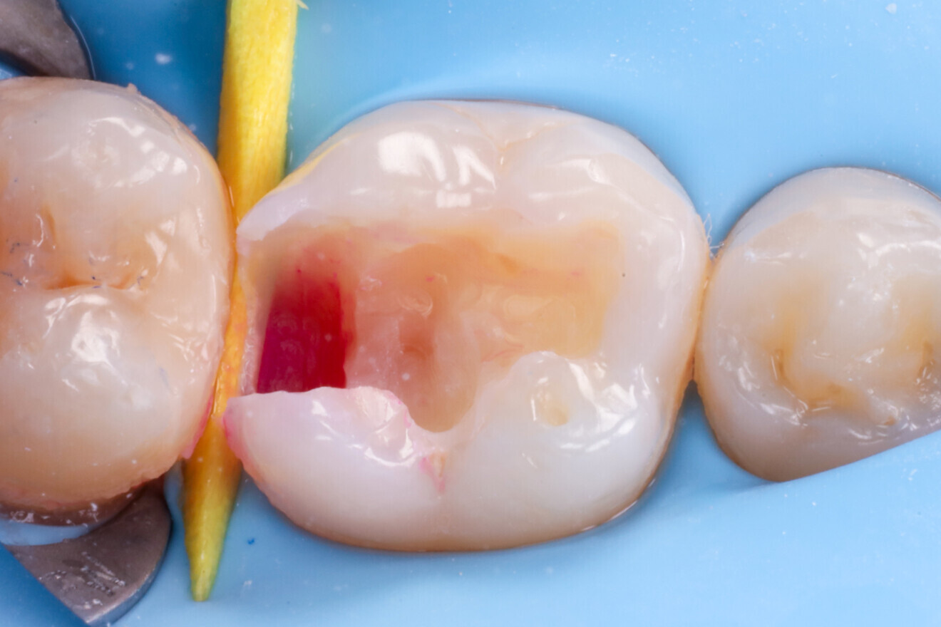 Fig. 5: Caries detection dye applied to visualise the extent of the carious lesion.