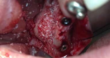 Rialzo del seno mascellare e contestuale inserimento di impianti