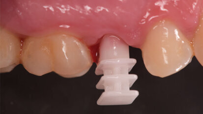 Impianto post-estrattivo a carico immediato in Zirconia