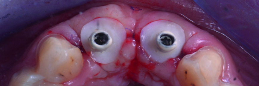 Figs. 19–20 : Élaboration des piliers provisoires avec un profil d’émergence naturel pour assurer le soutien de la gencive. 