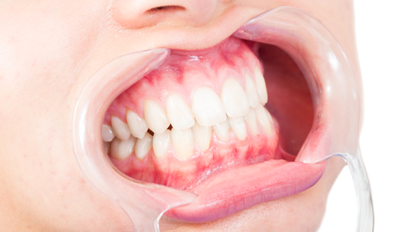 Expertentipp: Wichtige Aspekte zum Thema Full-Mouth-Disinfection