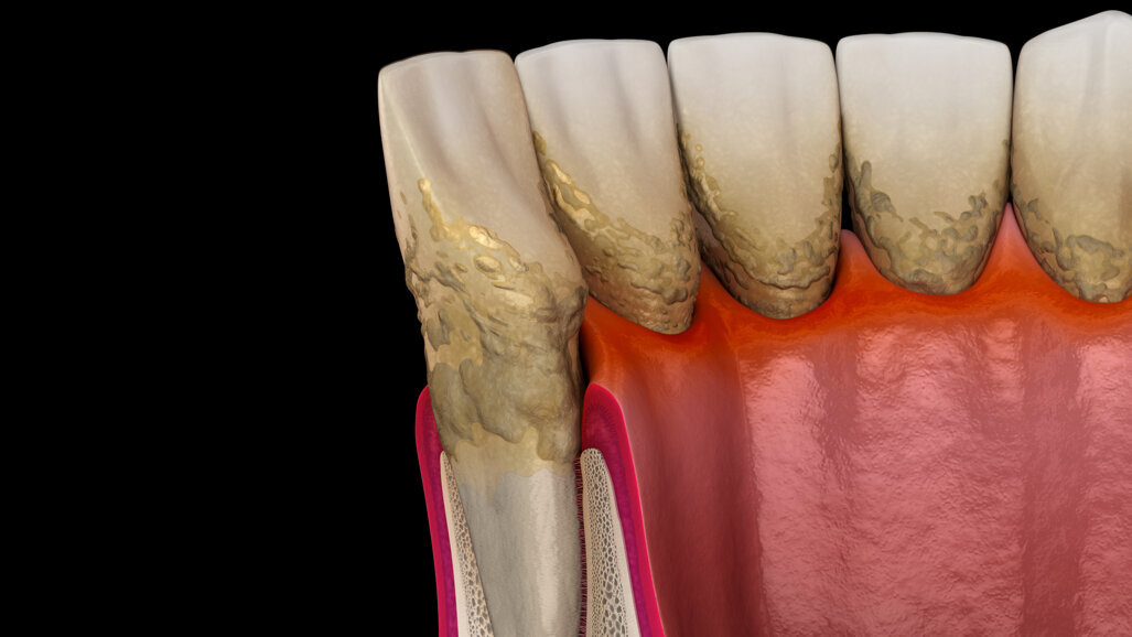 Researchers to develop novel antibiotic delivery system to treat aggressive periodontitis