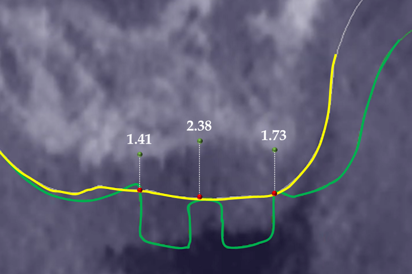 Fig. 6a: Dimensions (mm) of the gingiva at the end of the healing period. Comparison, before surgery (yellow line) and at the end of healing (green line), of the gingival height (GH) measured at the middle of the crest and on the buccal and palatal sides of the healing abutment.