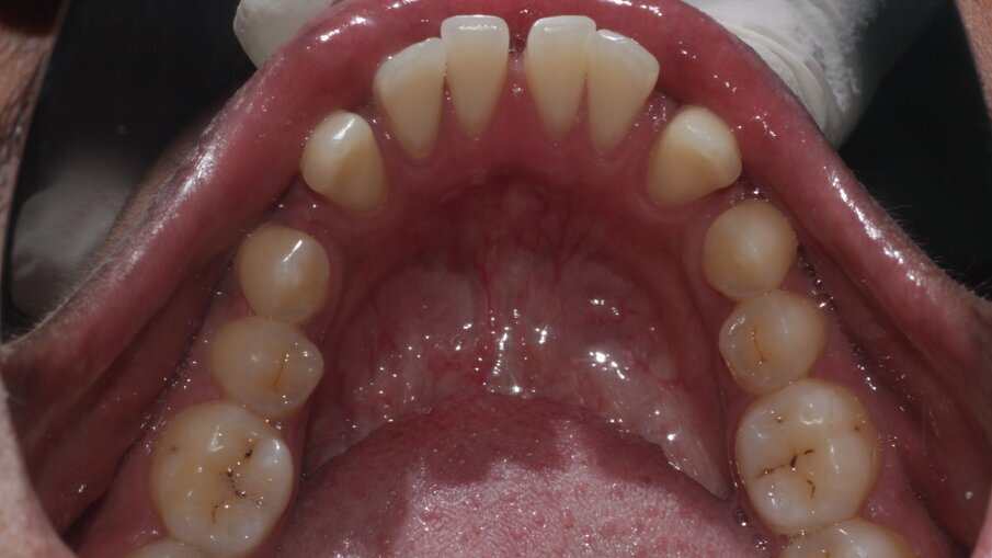 Fig 5: Mandibular Arch