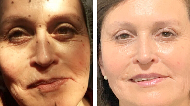 Armonización y rejuvenecimiento facial