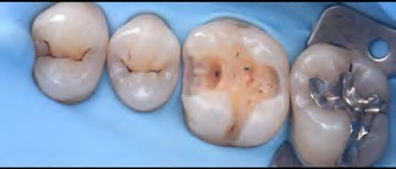 Fig. 2c: Adhesive procedure performed and the cavity restored using a direct resin composite technique. 