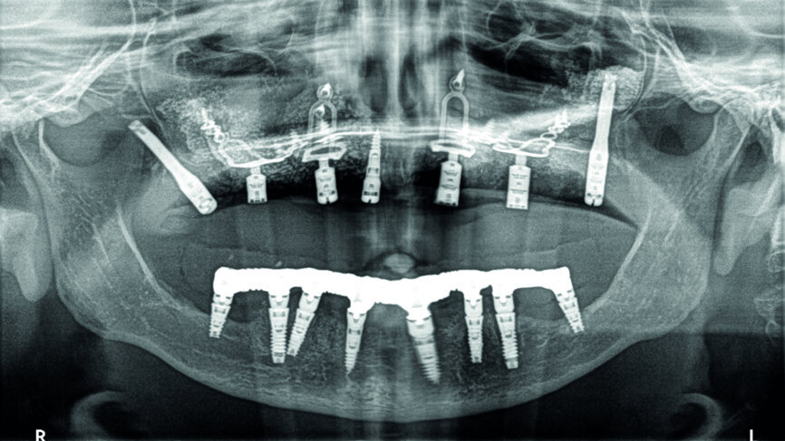 Cas 1d : Contrôle postopératoire des implants, à noter la présence de piliers transgingivaux qui faciliteront la gestion de l’esthetique lors de la confection du bridge d’usage (avec plusieurs hauteurs disponibles, nous les garderons ou les remplacerons).
