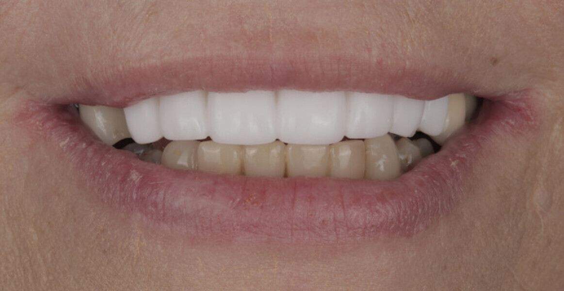 Fig. 5a: 3D-printed intra-oral mock-up to assess lip support and aesthetics. Frontal view (a). Frontal view with retracted lips (b). Occlusal view (c).