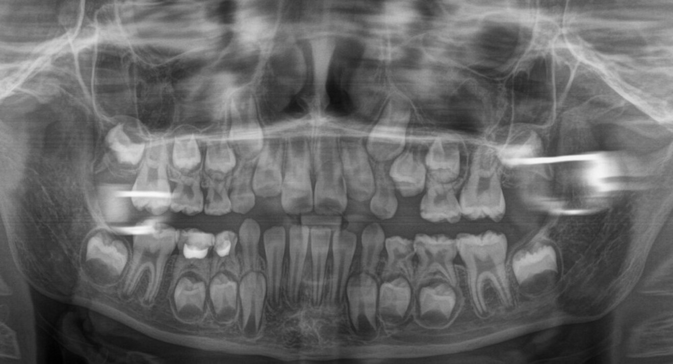 Fig. 4a: Pre-treatment panoramic radiograph.