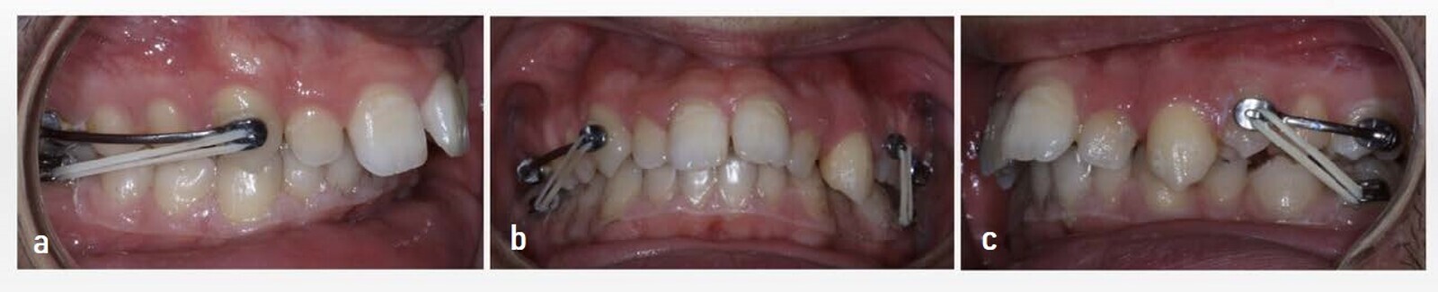Figs. 10a–c: Class II Carriere Motion Appliance placed on the maxillary left premolar and the button on tooth #37. 