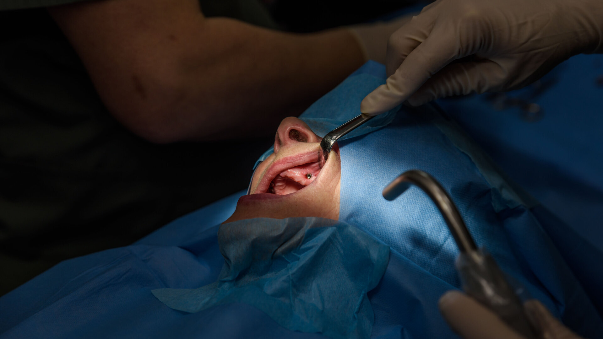 Implant treatment of the fully edentulous patient—contribution of digital techniques