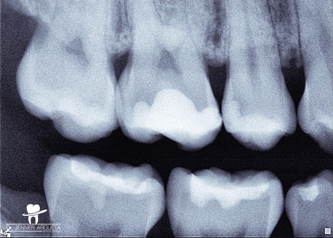 Fig. 2: Bitewing radiograph showing evidence of a deep restoration in tooth #16 at mesial level. Under-mineralised tissue was found close to the mesial pulp horn. 