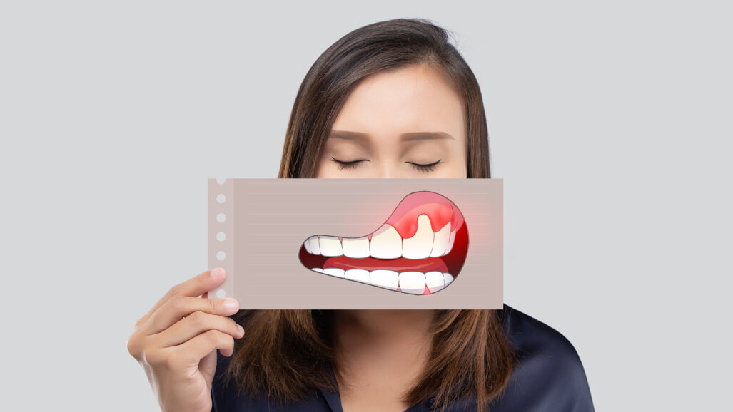 KZBV: Über 30 Millionen Deutsche sind an Parodontitis erkrankt