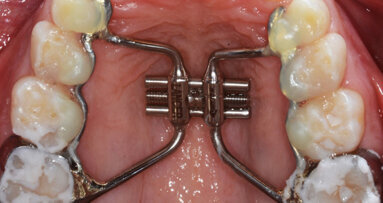 Effetto dell’Ibuprofene nella gestione del dolore  in pazienti sottoposti a espansione rapida del palato