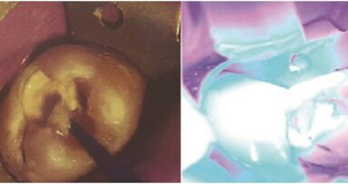 Biodentin „Jedan za sve“  -korak napred