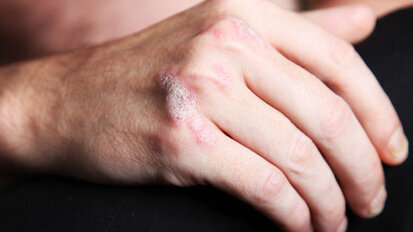 Smoking as a permissive factor of periodontal disease in psoriasis