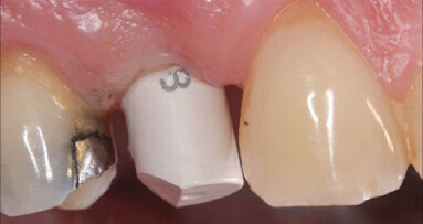 Zařízení na digitální otiskování 3Shape TRIOS® nyní i se skenováním implantátů