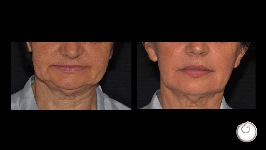 Prima e dopo il trattamento