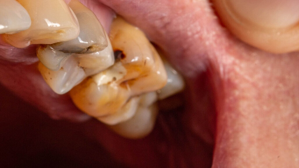 El 94% de los adultos en España tiene caries