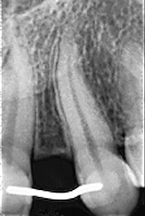 Fig. 7 : Présentation radiologique de la technique d’ouverture de l’espace interradiculaire. Il faut noter l’insertion des alésoirs manuels de 2,5 mm et 3,0 mm entre les racines, afin de préparer l’espace pour l’implant de Ø 3,0 mm, mis en place à 3,0 mm sous le niveau de l’os crestal.