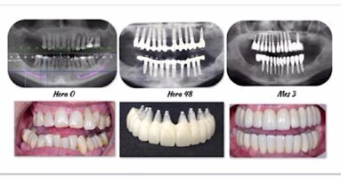Los beneficios de la implantología biodinámica