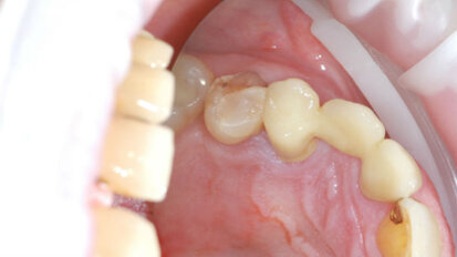 Ceramica ibrida per sollevatori di pesi