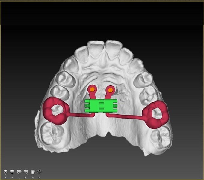 Fig. 6: Fabrication of the appliance ready for installation, based on intra-oral scanning and the implant placement plan. Guided implant placement and appliance installation are completed in a single visit. 