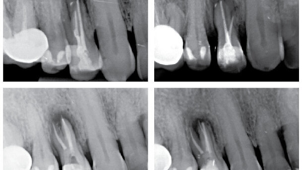 Když se příroda vysmívá endodontistům – dvě kazuistiky