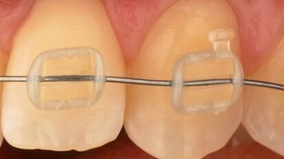 Des chercheurs espagnols développent une nouvelle génération de brackets invisibles