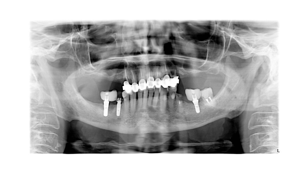 Fig. 1_Radiografia ortopanoramica iniziale della paziente, parte della valutazione diagnostica preliminare.