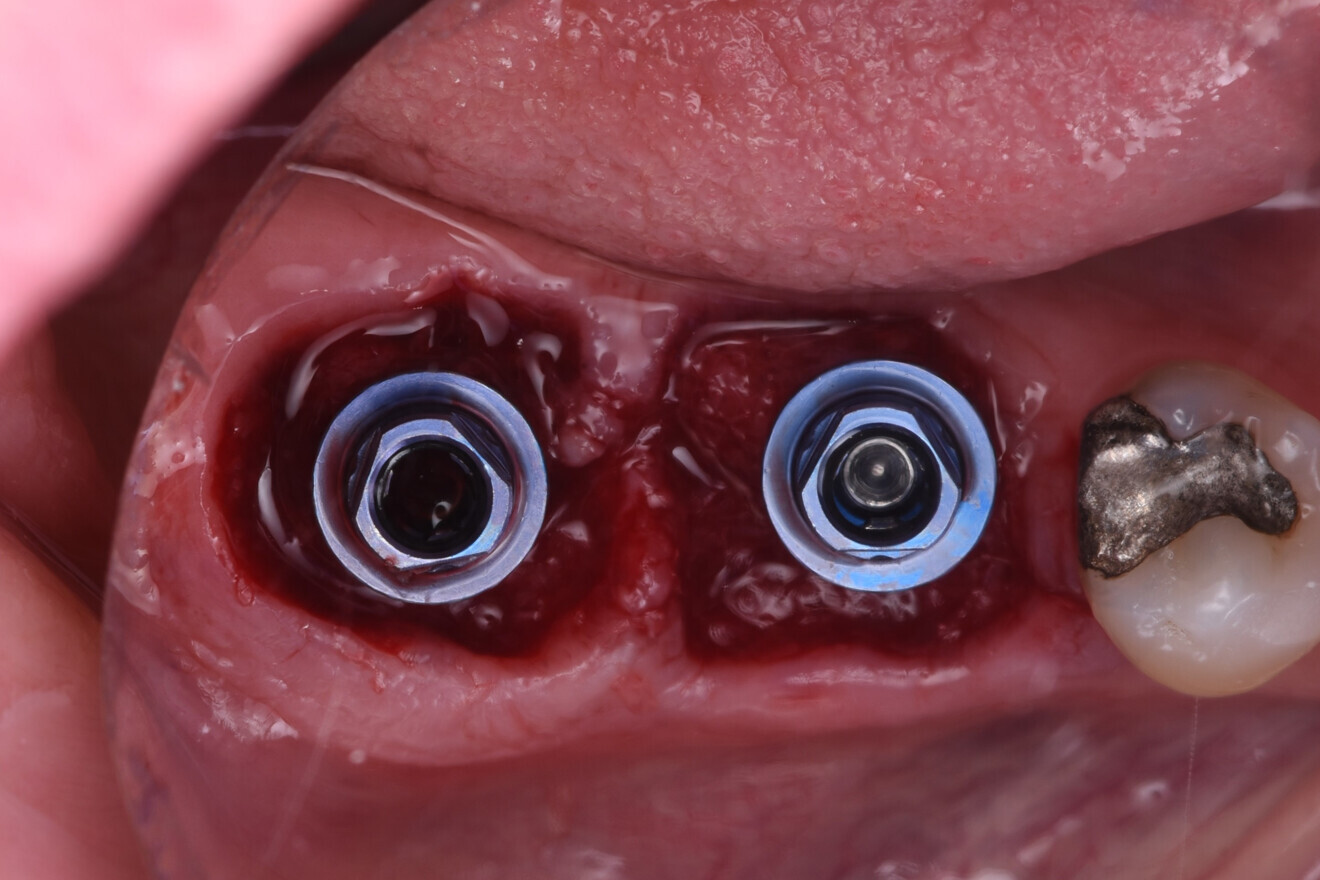 Fig. 10: Implants in place, situation after grafting.