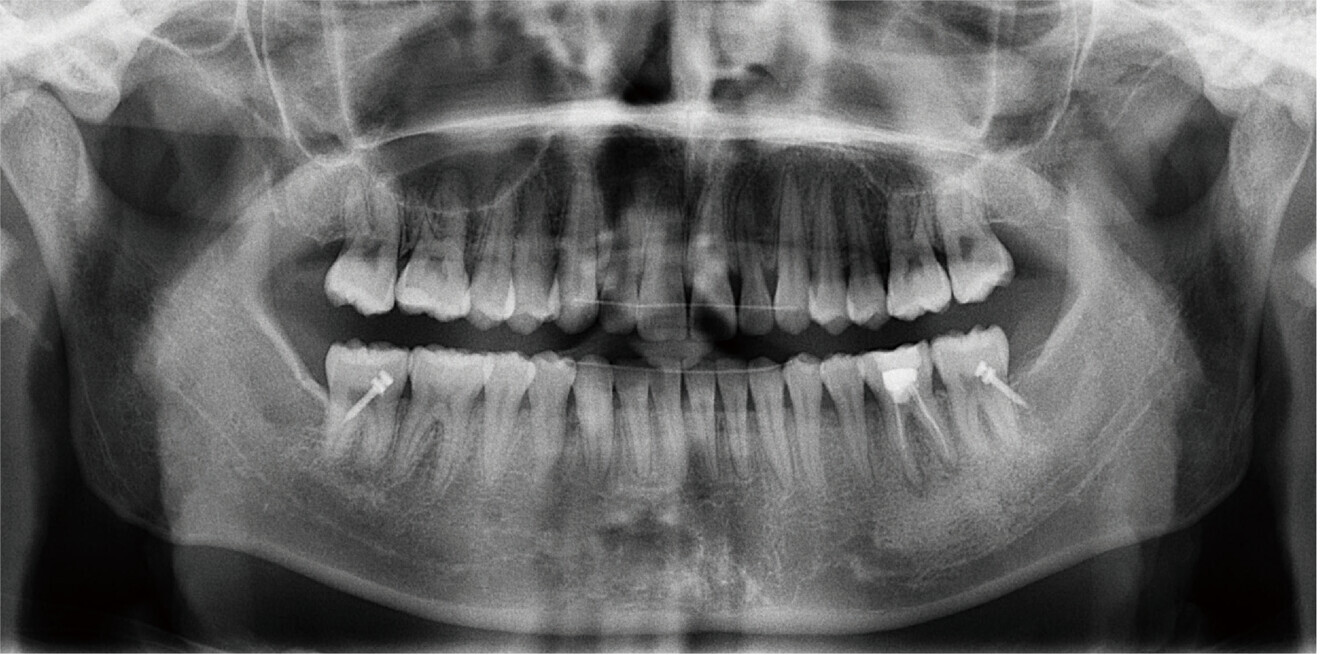 Fig. 5b: Dental panoramic tomogram taken after completion of mandibular repositioning therapy. 