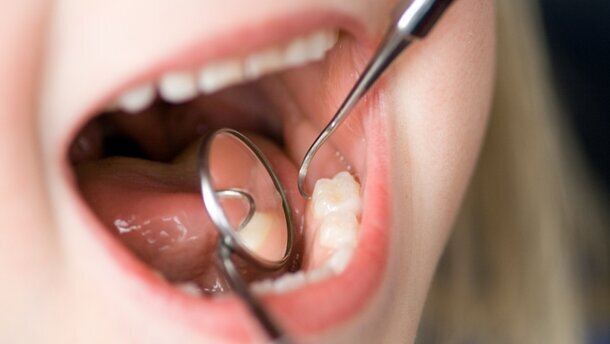 Parodontalerkrankungen im Kindheitsalter oft tragisch