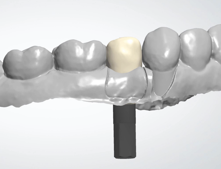 Fig. 10d_La programmazione della vite di guarigione custom deriva dalla copia della ceratura.