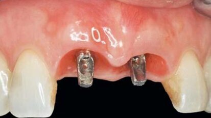 Czy recesja tkanki miękkiej wokół implantów wciąż jest nieunikniona? – część 2