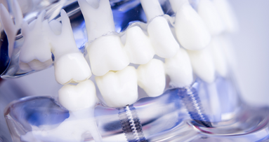 Bessere Osseointegration: Beschichtete Implantate entwickelt