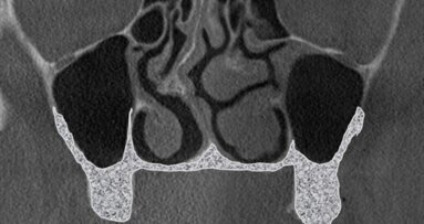 Podniesienie dna zatoki szczękowej z dostępu od strony podniebiennej jako metoda alternatywna