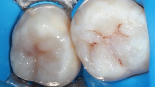 Funkcjonalna odbudowa estetyczna w odcinku bocznym – opis przypadku