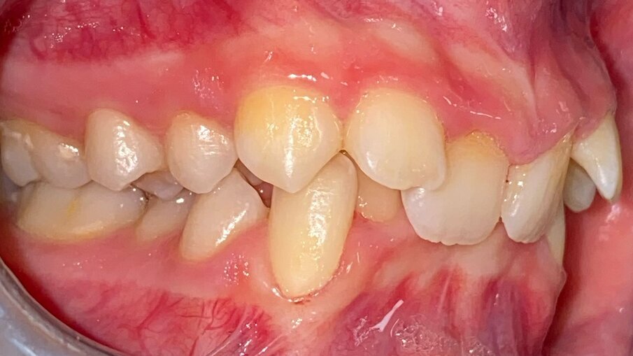 Fig. 6_Laterale destra pre-trattamento.