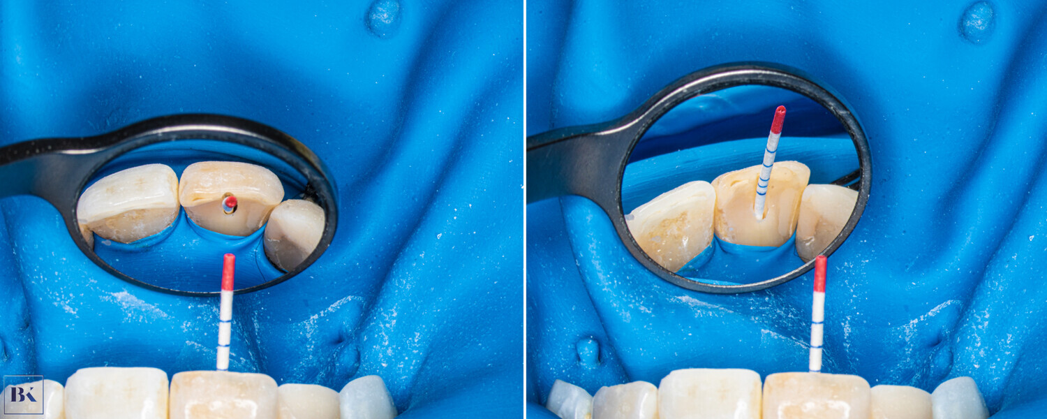 Figs. 9a & b: Drying the canal before obturation.