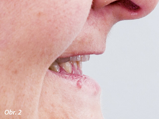 Značně zkrácené korunky zubů v důsledku bruxismu