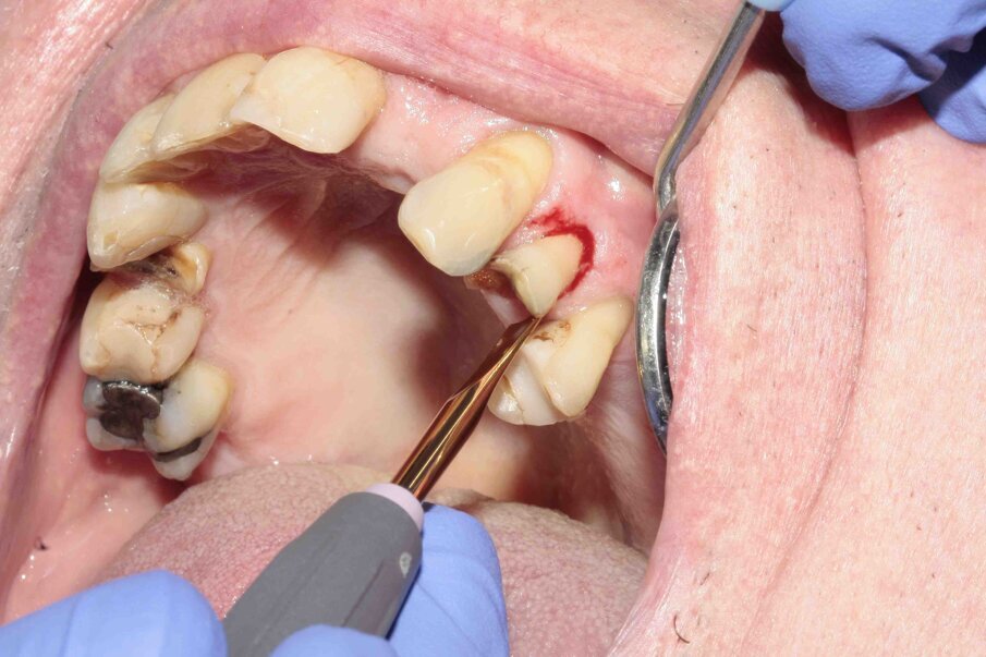 Figs. 2–4: The tooth was luxated with Luxator P4 (dual edge, lilac).
